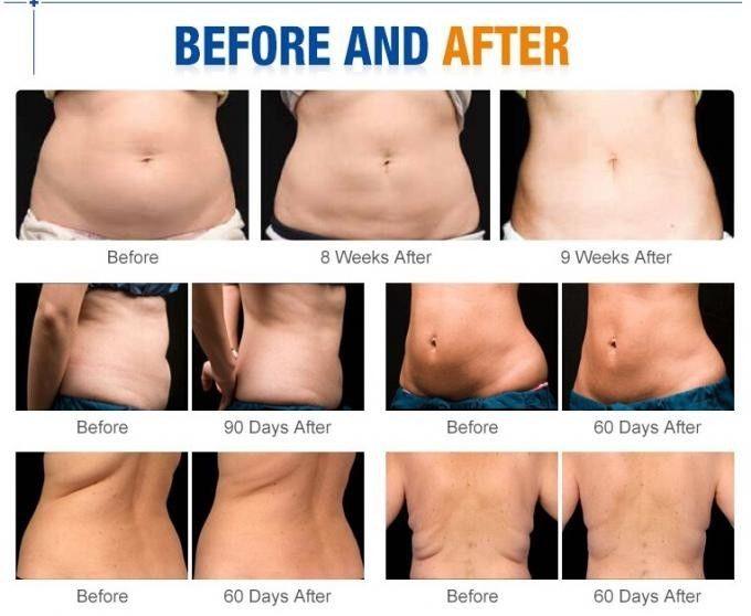 Cavitation Treatment Benefits