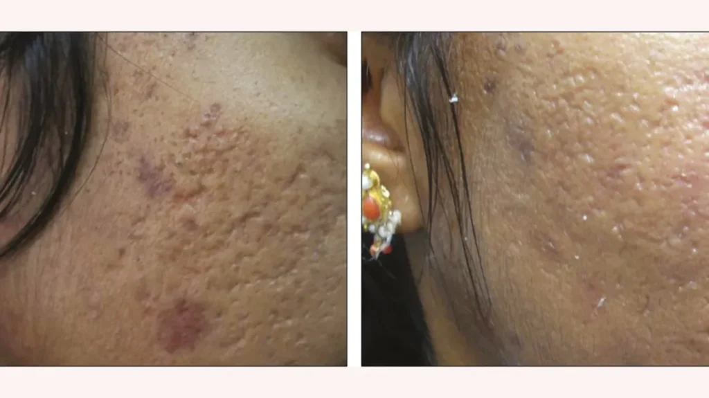 Best Devices for Acne and Scarring Treatments