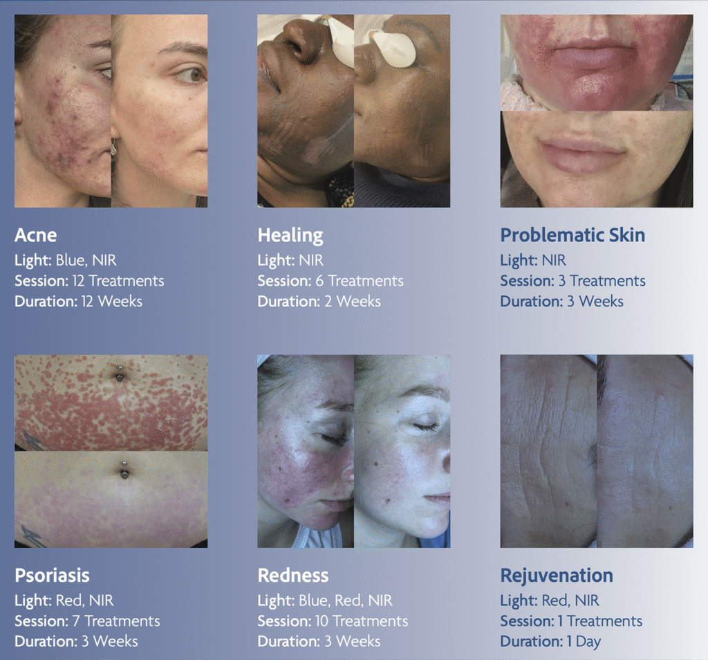 Side Effects of Red Light Therapy